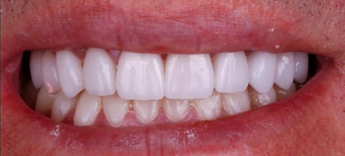 The same Love Dental patient smile after treatment