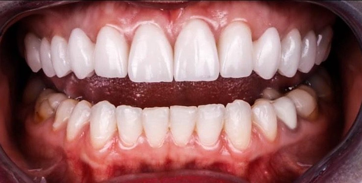 The same Love Dental patient smile after treatment