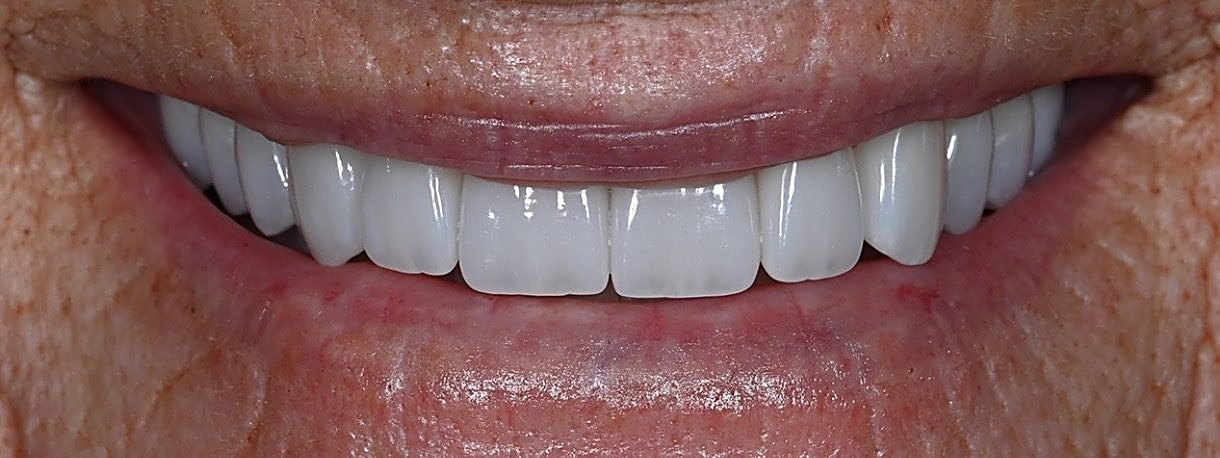 The same Love Dental patient smile after treatment