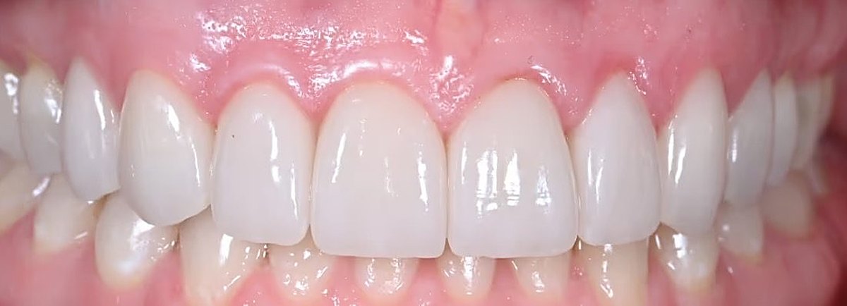The same Love Dental patient smile after treatment