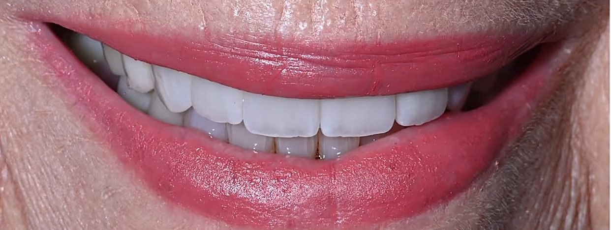 The same Love Dental patient smile after treatment