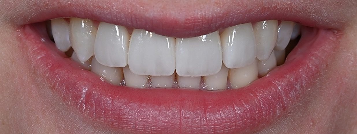 The same Love Dental patient smile after treatment