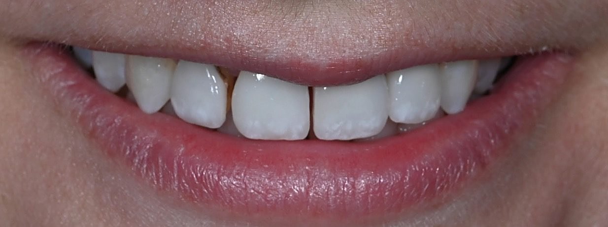 Real Love Dental patient smile before treatment