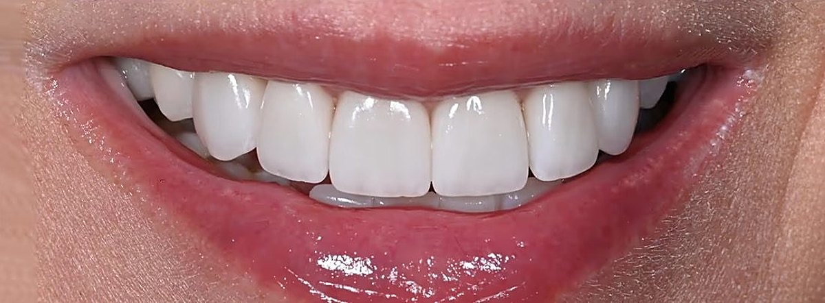 The same Love Dental patient smile after treatment