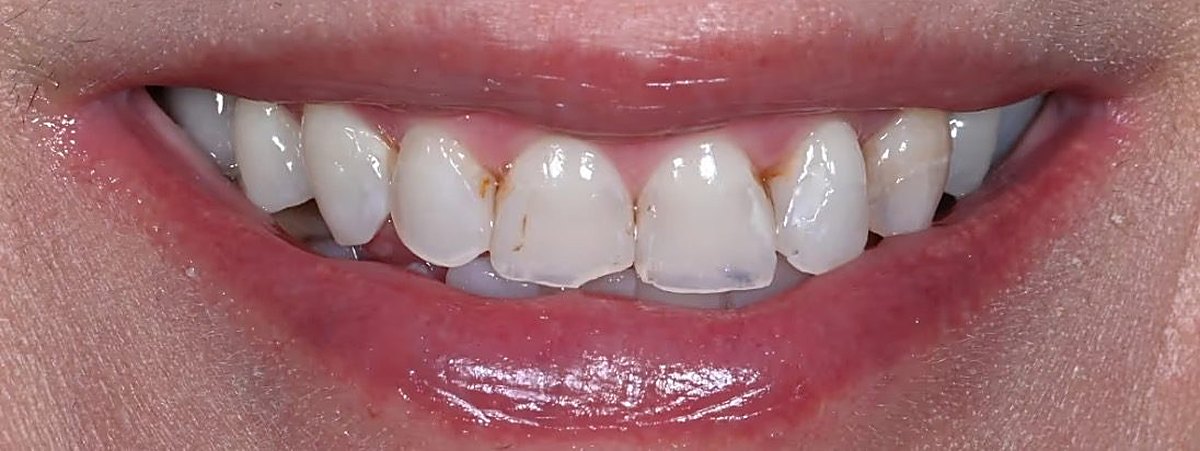 Real Love Dental patient smile before treatment